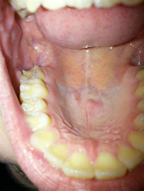 Photos Of Cancer On The Roof Of The Mouth