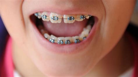 After that, switch to wearing it at night, every night, if you want to keep your teeth straight for the rest of your life. Want straight teeth? Brace retainers 'should be worn for ...