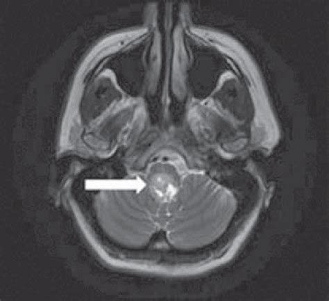 Case Study 1 Mri T2 Axial View Showing Fourth Ventricle Ependymoma