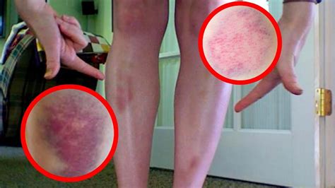 Learn The Reason Why Unexplained Bruises Might Appear On Your Body
