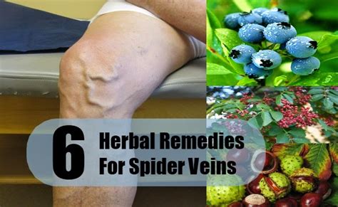 6 Herbal Remedies For Spider Veins ~ Mzizi Mkavu