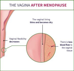 Painful Sex After Menopause Vulvar Vaginal Atrophy Vva
