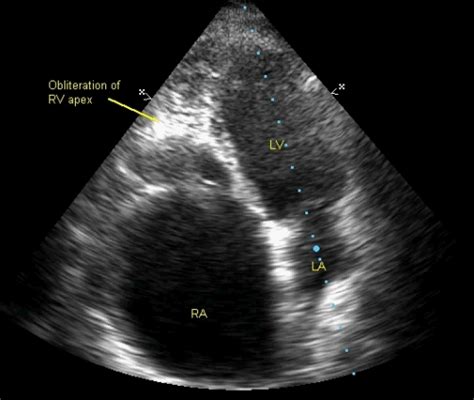 Right Ventricular Endomyocardial Fibrosis Echocardiographic Profile
