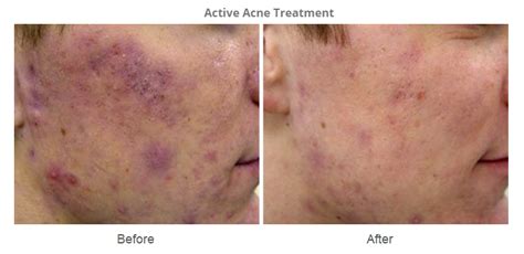Acne And Acne Scar Revision Beautouch Medi Aesthetics Clinic