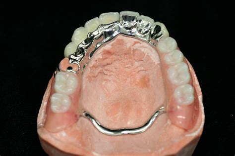 Removable Denture Laboratory Cast Partial Framework Implant