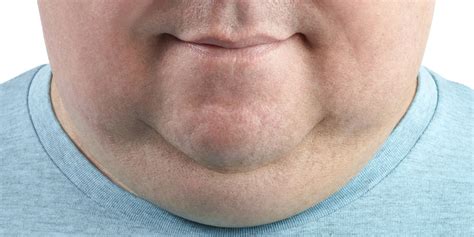 how to get rid of double chin causes and treatments