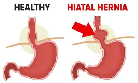 Hiatus Hernia Explained And A Possible Way Cure Justpasteit