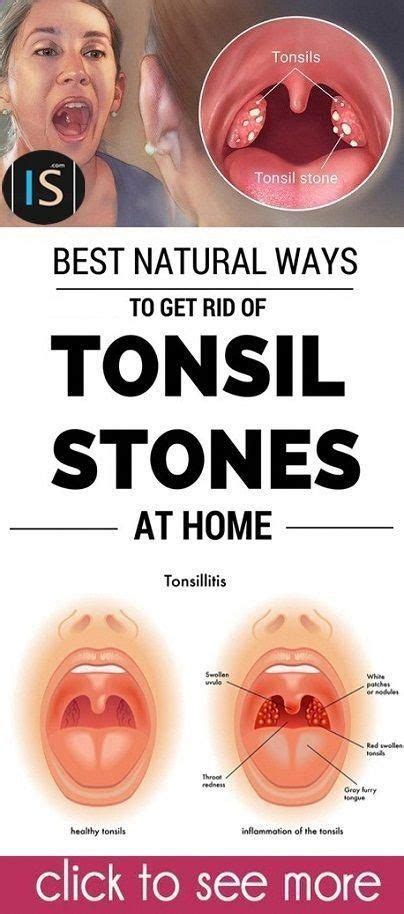 Pin On Tonsil Stone Remedies