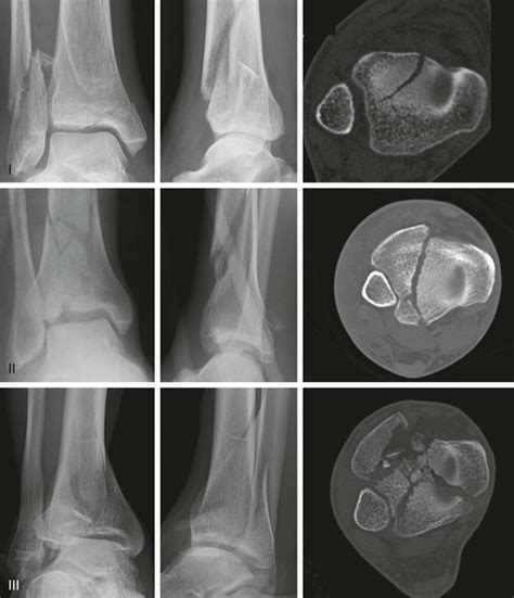 Distal Tibial Plafond Fracture