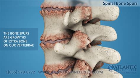 The internet backbone may be defined by the principal data routes between large, strategically interconnected computer networks and core routers of the internet. Spinal Bone Spurs - YouTube