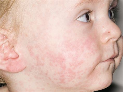 Individualität Verkäufer Usa West Nile Virus Rash In Toddlers Säugling