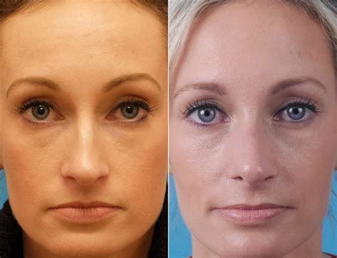Nasal Bump Before And After Photos Becker Rhinoplasty Center
