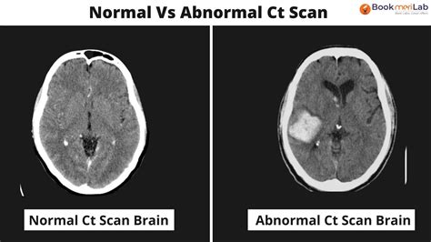 Ct Scan Brain Purpose Results Cost Bookmerilab