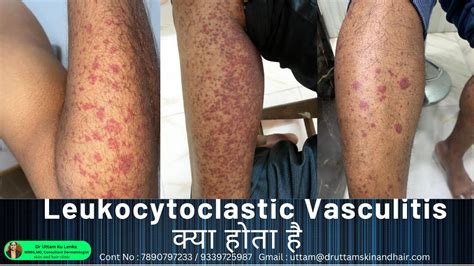 Leukocytoclastic Vasculitis Sudden Red Rashes Red Spot On Leg