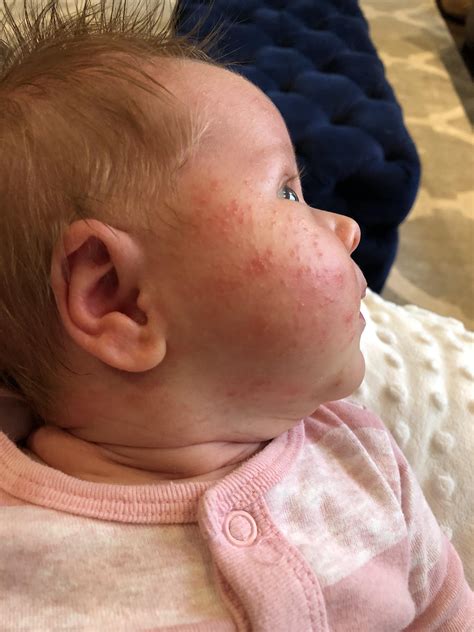 Baby Acne Or Milk Allergy Breastfeeding