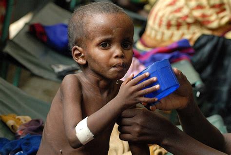 Malnutrition Global Pandemic Affects One Third Of Worlds Population