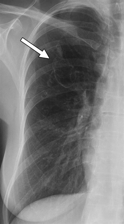 Multiple Cystlike Lung Lesions In The Adult Ajr