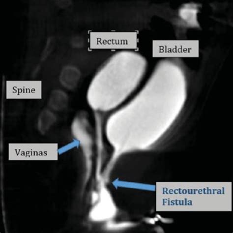Pdf Imperforate Anus And Rectourethral Fistula In A Female
