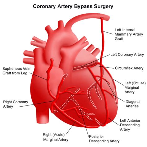 Coronary Artery Bypass Graft Coronary Artery Bypass Graft Surgery