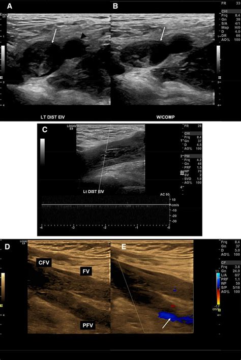 Duplex Ultrasound In The Diagnosis Of Lower Extremity Deep Venous
