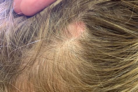 LUPUS ERITEMATOSO | Alloi Cagalli Presta - Studio ...