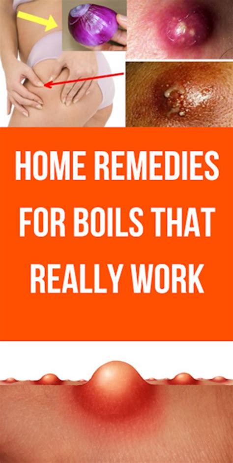 Home Remedies For Boils That Really Work Gonnee Lifestyle Home