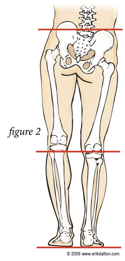 Leg Length Discrepancy Symptoms Warwick Enterprises