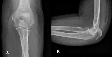 Cureus Olecranon Fracture In An Older Adult Treated With Locking