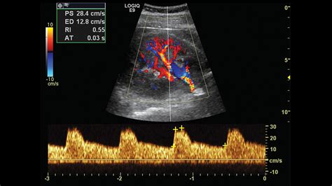Segmental Renal Artery Ultrasound