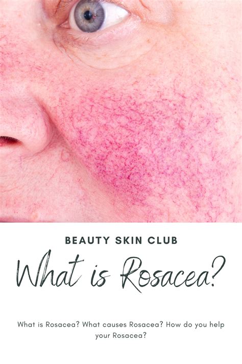 What Is Rosacea Rosacea What Causes Rosacea Beauty Skin