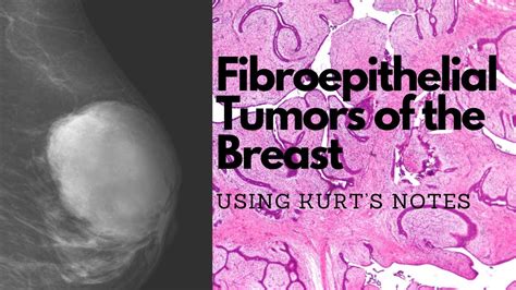 Fibroadenomas And Phyllodes Tumor Of The Breast Using Kurts Notes