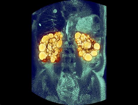 Polycystic Kidneys Mri Scan Photograph By Du Cane Medical Imaging Ltd