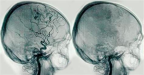 Angiografía cerebral qué es y cómo se usa en neurología