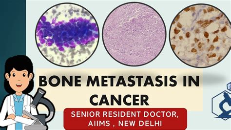 Bone Metastasis In Cancer Symptoms And Diagnosis A Case Based Study