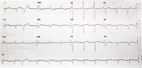 Understanding Electrocardiogram Ecg Murmurs Nhcs