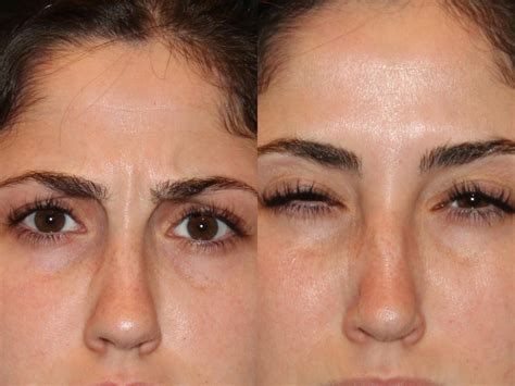 Botox® Cosmetic Before And After Pictures Case 99 Atlanta Georgia
