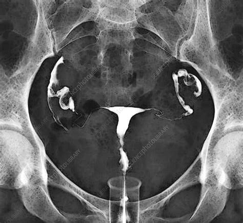 X Ray Anatomy Female Reproductive Vector Illustration