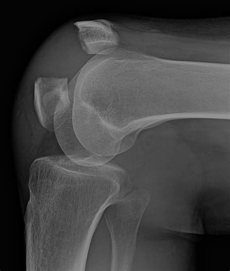 Patella Fracture — Adam B Cohen Md