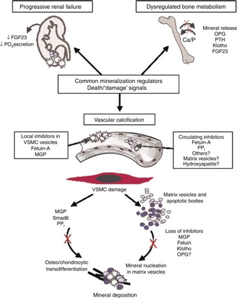 Exploring The Biology Of Vascular Calcification In Chronic Kidney