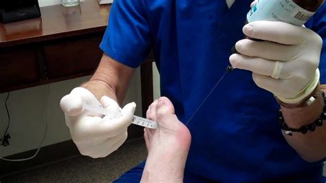 Gout With A Cortisone Injection For Relief By Tampa Podiatrist Dr Leo