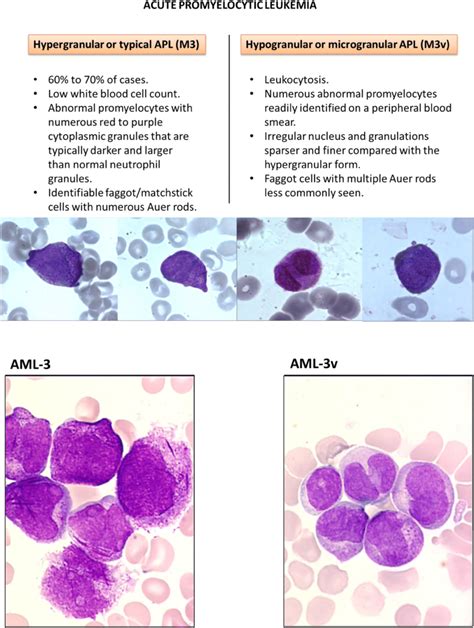 Acute Promyelocytic Leukemia A History Over 60 Years—from The Most