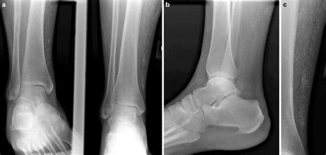 Soft Tissue Calcifications In The Lower Extremities Of Severely