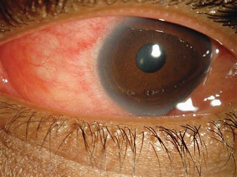 Facts And Fiction About Adenoviral Conjunctivitis