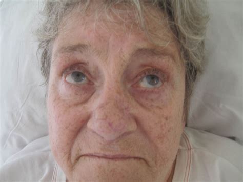 spontaneous up gaze in a 62 year old woman with lithium intoxication download scientific