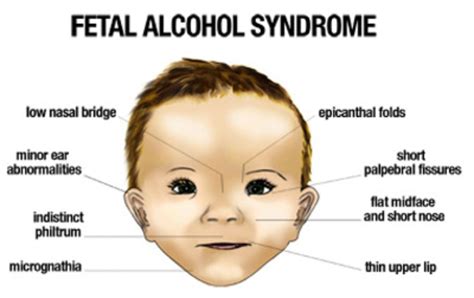 Fetal Alcohol Syndrome Derek Napiers Health Website