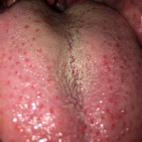 Sieht meine Zunge normal auß? (Zungenbelag)