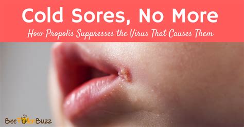 That includes boobs, butts, and your weird eyebrows. Cold Sores No More: How Propolis Supresses the Virus That ...