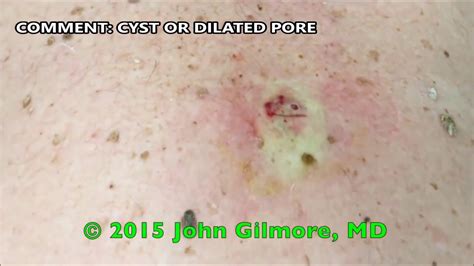 Dilated Pore Of Winer Or Infected Cyst Popped Nsfe Youtube