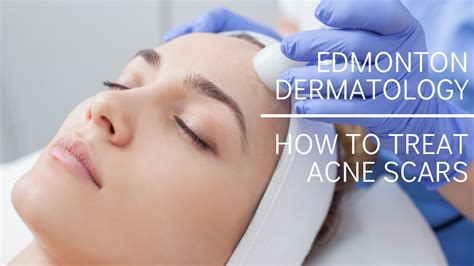 Edmonton Dermatology How To Treat Acne Scars Youtube