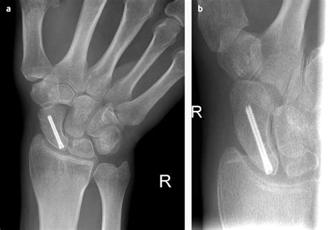 Proximal Scaphoid Fracture My XXX Hot Girl